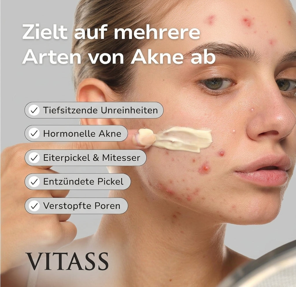 Anti Akne Creme - Gemacht für Empfindliche haut