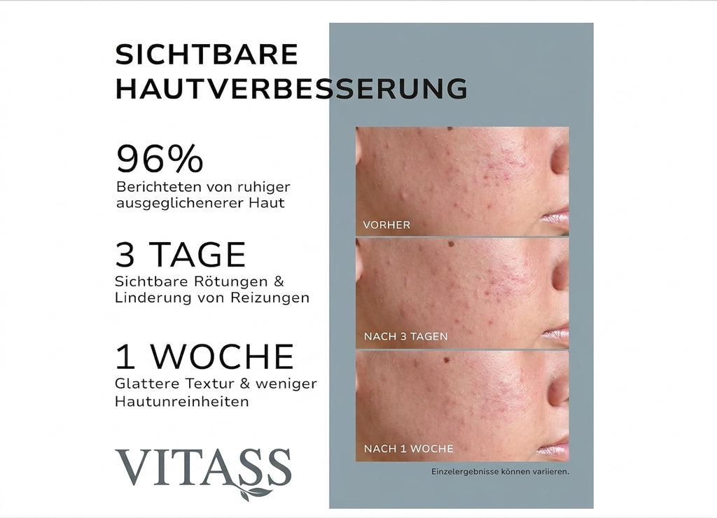 Anti Akne Creme - Gemacht für Empfindliche haut